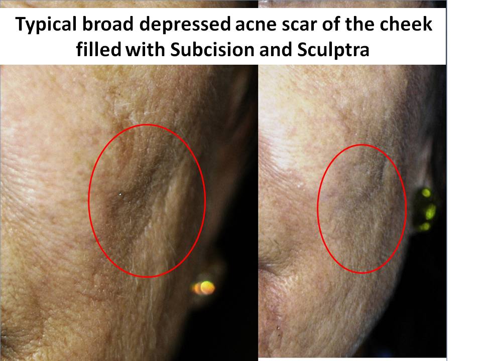 Acne Scar - Sadove Cosmetic Surgery
