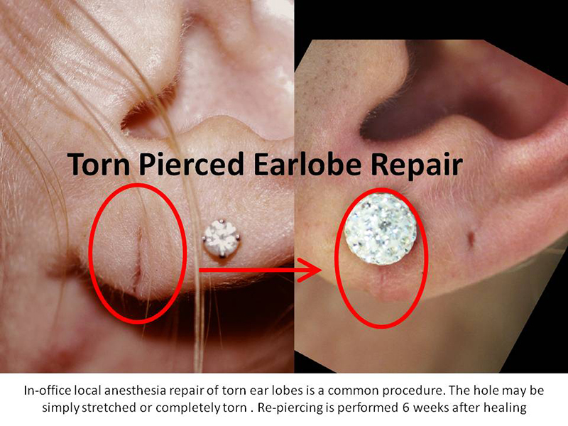 In Office Ear Lobe Repair Surgeon Los Angeles, Beverly Hills, Glendale CA  Ear Lobe Repair Specialist