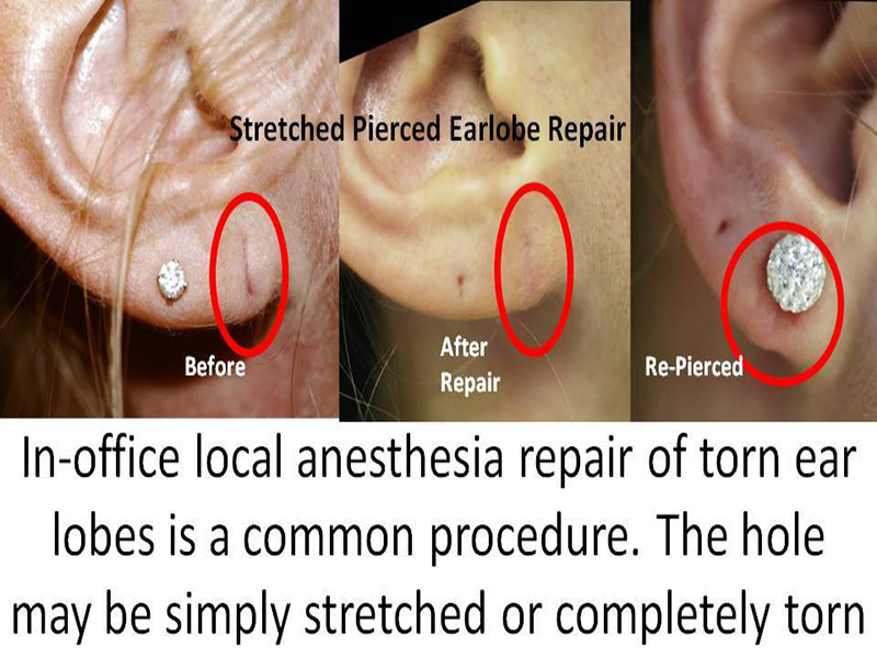 Ear Lobe Repair - Sadove Cosmetic Surgery