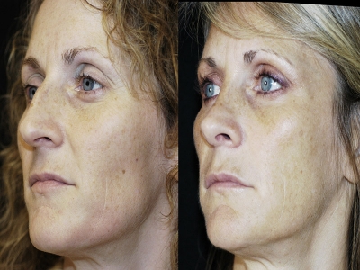 Nose Surgery - Sadove Cosmetic Surgery