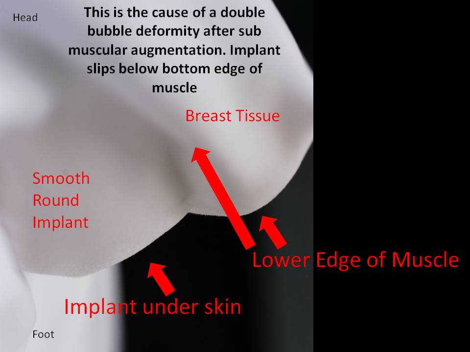 Correction of Painful Breast Implant Problems or animation