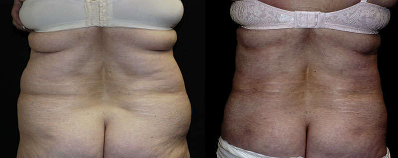 https://www.sadoveplasticsurgery.com/wp-content/uploads/2015/08/Liposuction-Muffin-Top-Hips1.jpg