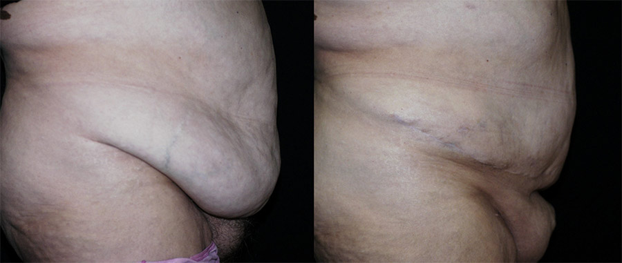 Before and after lateral view Panniculectomy - Sadove Cosmetic Surgery